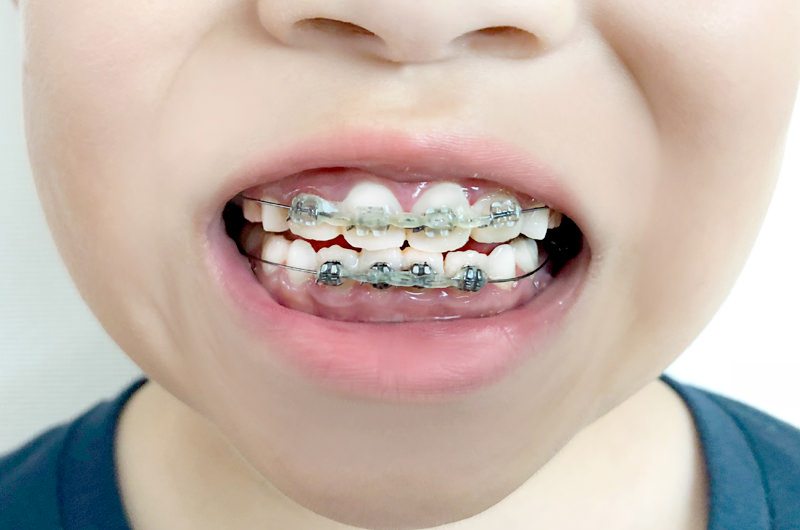 4システムで前歯を整える