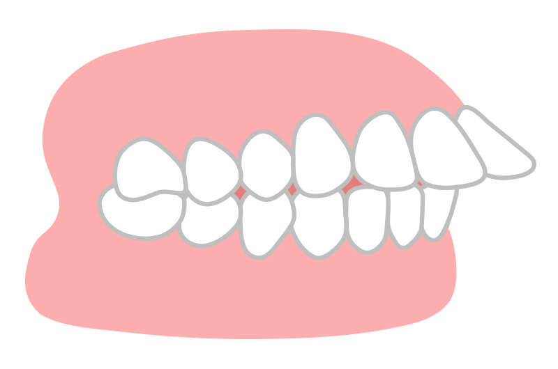 上顎前突(出っ歯)