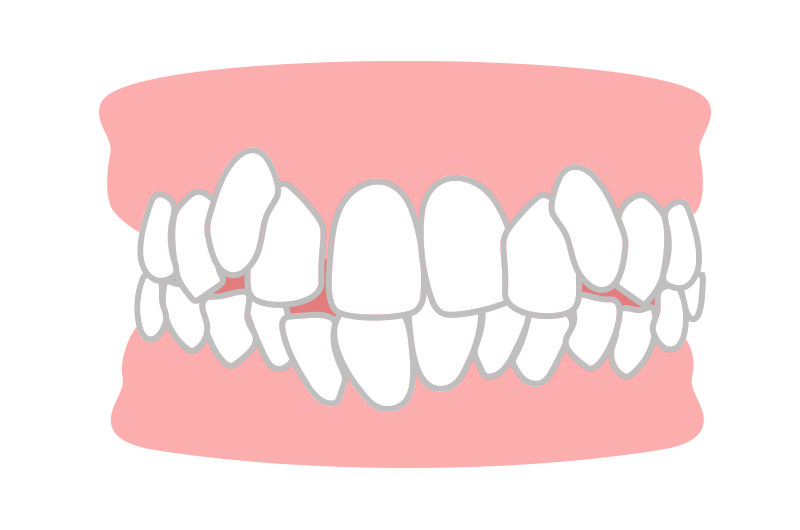 八重歯・叢生(でこぼこ)