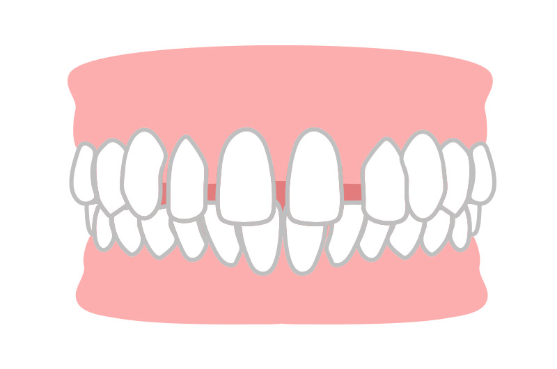 空隙歯列(すきっ歯)