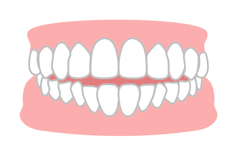 開咬(オープンバイト)