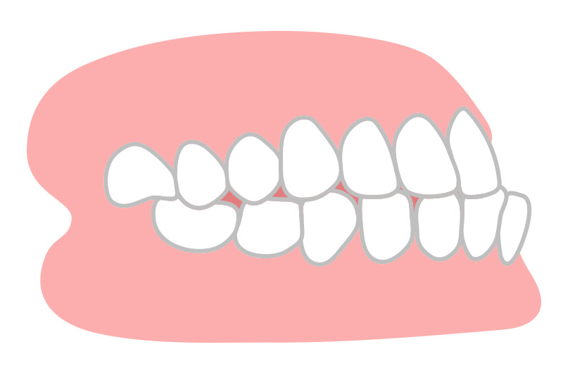 下顎前突(受け口)