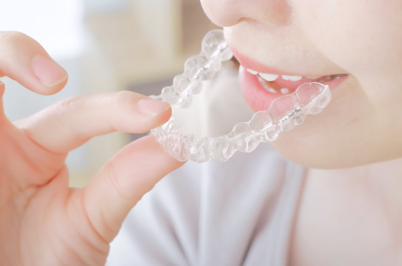 マウスピース矯正とは?