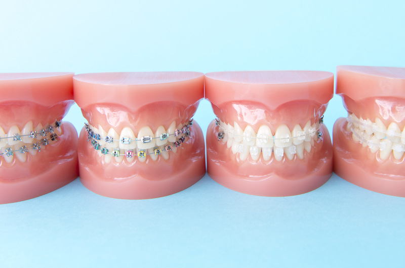 ワイヤー矯正とは?